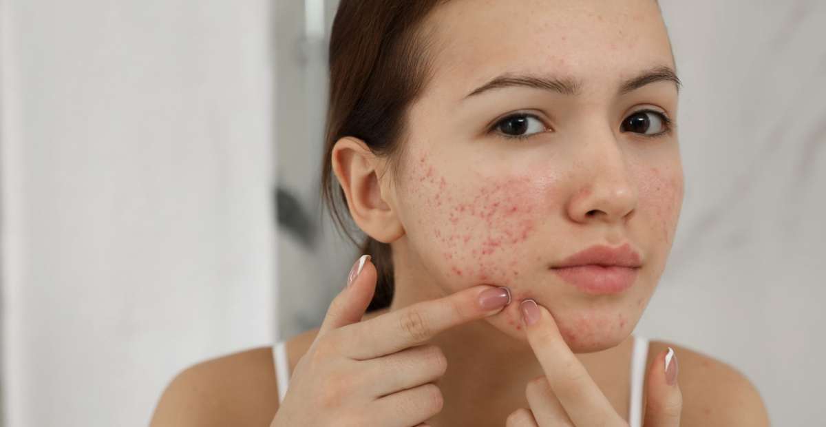 Jerawat? Santai! Tips Mengatasi dan Memilih Produk Skincare Tepat Remaja Belia, Lebih Percaya Diri
