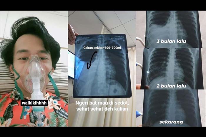 Perjuangan Pria Ini Berhenti Merokok dengan Menggigit Permen Karet Setelah Diagnosa Efusi Pleura dan TBC