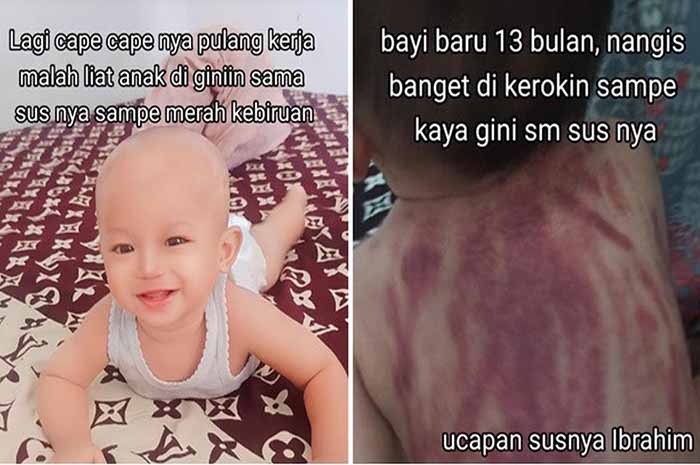 Kisah Viral: Bayi 13 Bulan Dikerok dengan Koin oleh Baby Sitter, Punggung Merah Memar