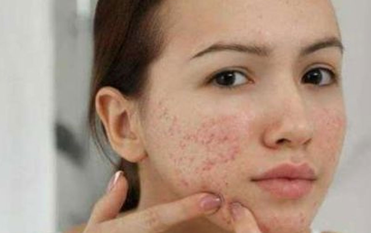 Mengendalikan Jerawat: Rekomendasi Skincare dari Ahli Kulit