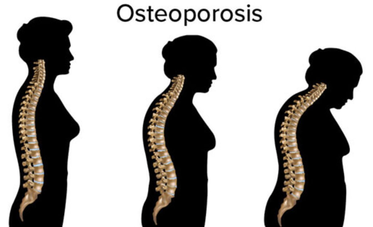 Yuk Cegah Osteoporosis dengan Mudah: Konsumsi Rebusan Biji Durian dan Petai, Tips dari dr. Zaidul Akbar