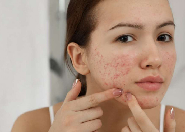 Jerawat? Santai! Tips Mengatasi dan Memilih Produk Skincare Tepat Remaja Belia, Lebih Percaya Diri