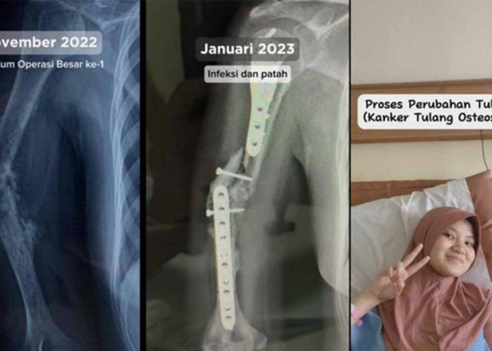 Kisah Viral Wanita Bandung Terkena Kanker Tulang Setelah Dikira Pegal Biasa!