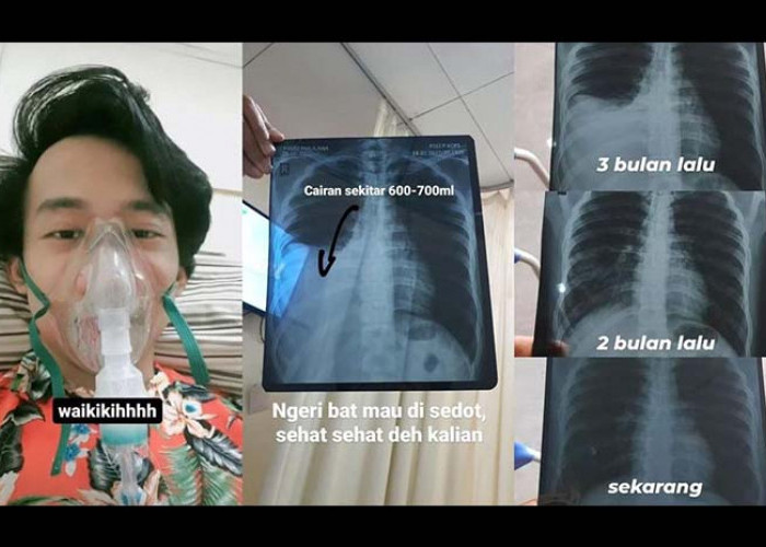 Perjuangan Pria Ini Berhenti Merokok dengan Menggigit Permen Karet Setelah Diagnosa Efusi Pleura dan TBC