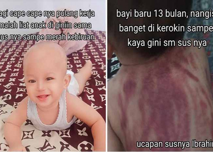 Kisah Viral: Bayi 13 Bulan Dikerok dengan Koin oleh Baby Sitter, Punggung Merah Memar