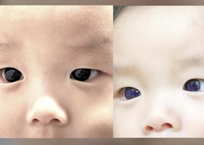 Viral Perubahan Warna Mata Bayi di Thailand: Dari Coklat Tua ke Biru Cerah setelah Pengobatan COVID-19!