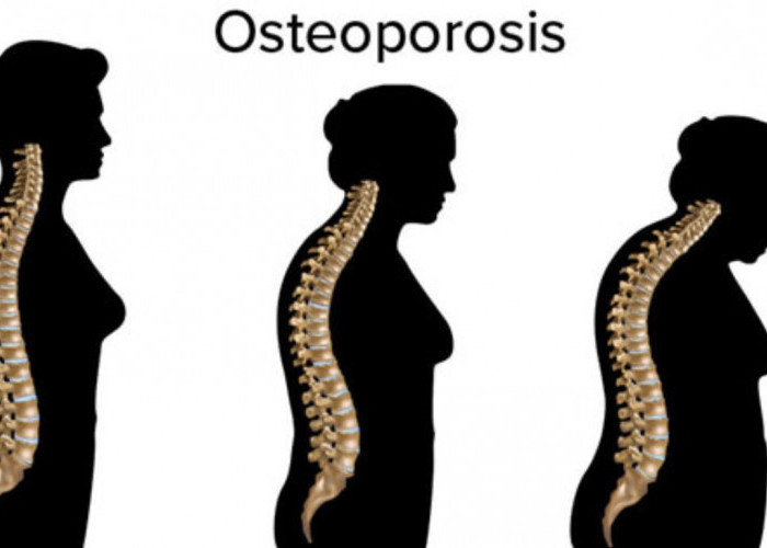 Yuk Cegah Osteoporosis dengan Mudah: Konsumsi Rebusan Biji Durian dan Petai, Tips dari dr. Zaidul Akbar